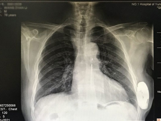 图为患者术后x光片.(供图)