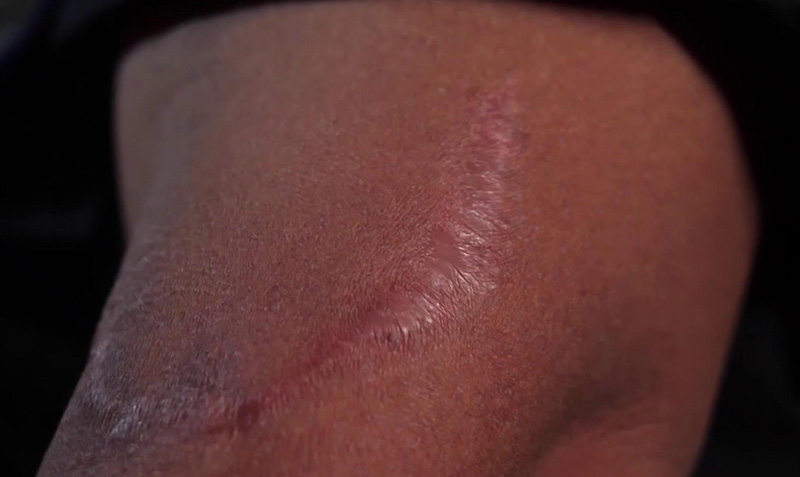 民警手臂上的伤疤。视频截图