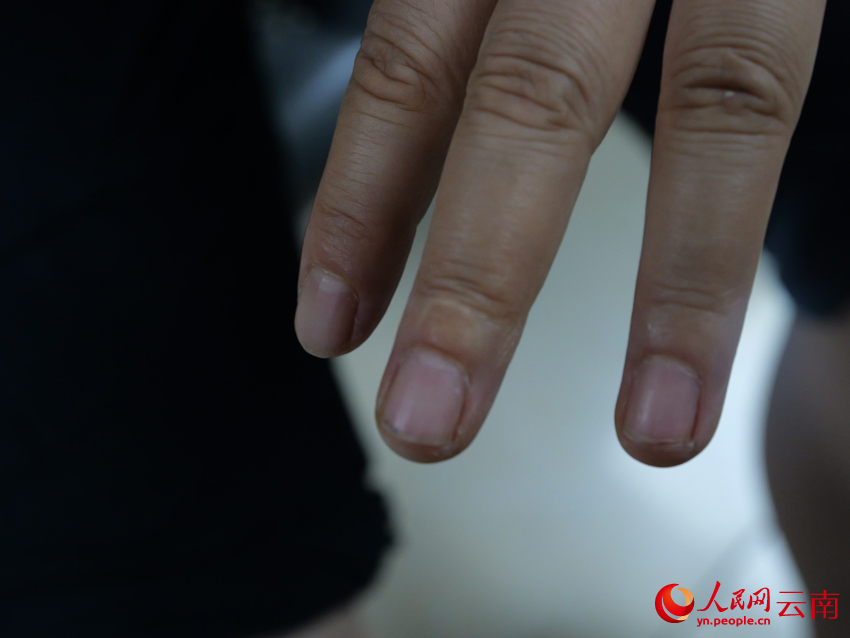 中指骨折后留下的疤痕。侯維靜攝
