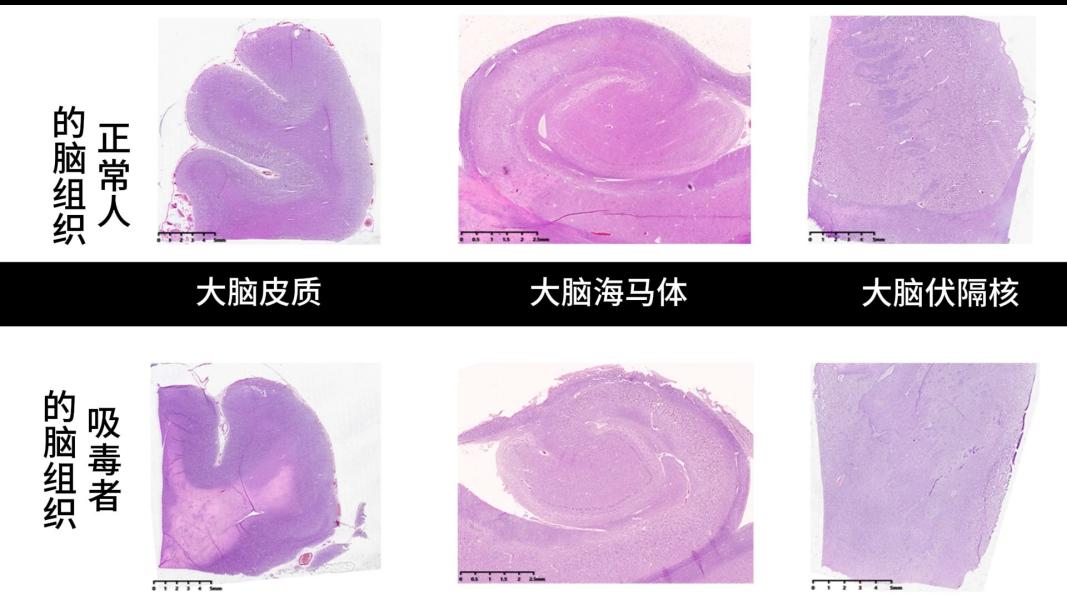 毒品对人的大脑组织损害对比图。受访者供图