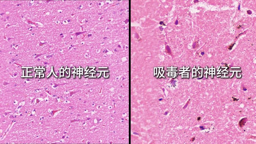 毒品对人体神经元的损害对比图。受访者供图