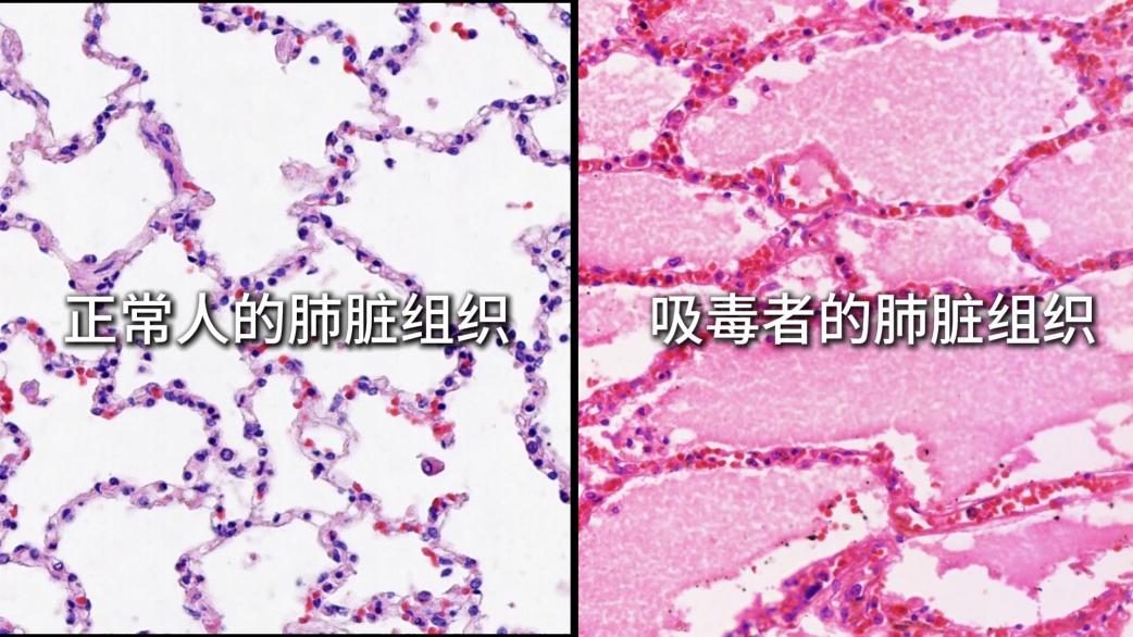 毒品对人的肺脏组织损害对比图。受访者供图