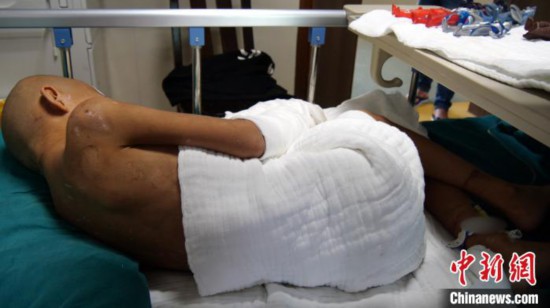 7歲男童被燙傷或面臨截肢律師:其父涉故意傷害罪